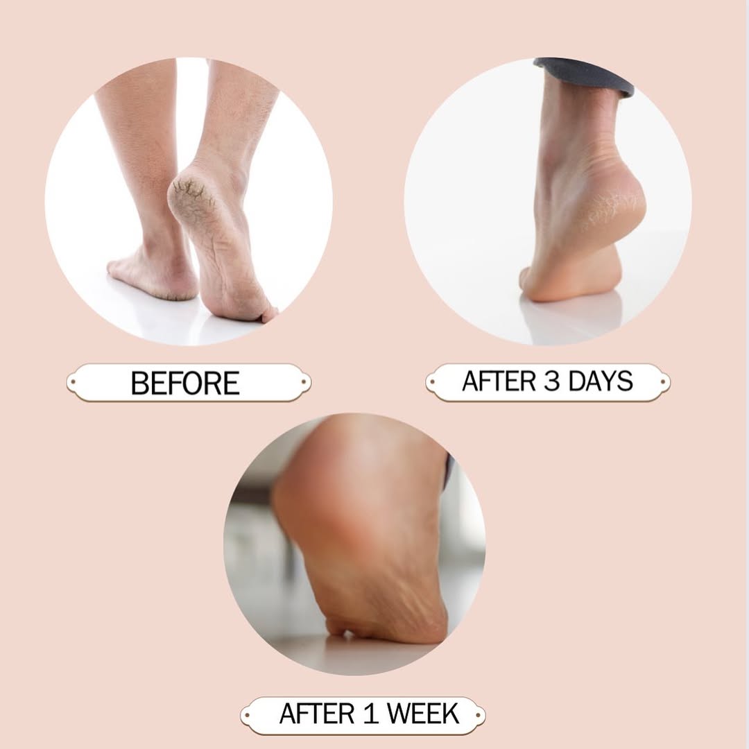 Heel Moisturizing Socks, Softens and Prevents Cracked Heels, Exfoliating Heel Protectors