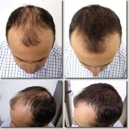 FEG Plus Hair Growth Spray – 50ml