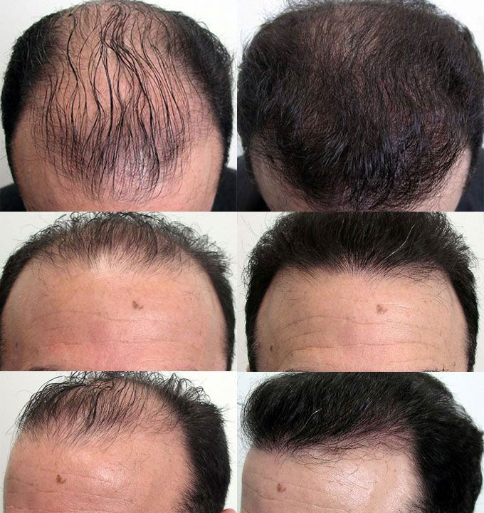FEG Plus Hair Growth Spray – 50ml