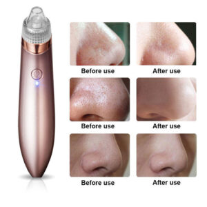 electric black head remover