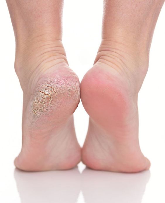 Silicone Moisturizing Gel Heel Socks